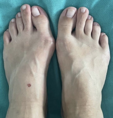 Шишка на стопе, косточки на стопах ног лечение, операции на шишках стоп, операция удаления шишки на стопе, шишка на большом пальце стопы операция, косточка на стопе операция, операция по удалению косточки на стопе, операция на косточке большого пальца стопы, операции стопы косточек на ногах, операция на косточке стопы цена, удаление косточки на стопе название операции.