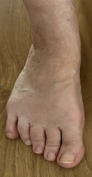 Шишка на стопе,
операции на шишках стоп,
операция удаления шишки на стопе,
шишка на большом пальце стопы операция,
косточка на стопе операция,
операция по удалению косточки на стопе,
операция на косточке большого пальца стопы,
операции стопы косточек на ногах,
операция на косточке стопы цена,
удаление косточки на стопе название операции.  