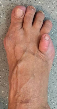 Фото до SCARF остеотомии, молоткообразные пальцы молоткообразная деформация пальцев молоткообразные пальцы стопы молоткообразная деформация пальцев стопы молоткообразные пальцы на ногах лечение молоткообразных пальцев молоткообразный палец операция молоткообразная деформация 2 пальца корректор молоткообразного пальца молоткообразный 2 палец стопы молоткообразный второй палец молоткообразные пальцы на ногах лечение молоткообразная деформация 2 пальца стопы молоткообразная деформация пальцев ног молоткообразные пальцы стопы операция лечение молоткообразной деформации пальцев молоткообразная деформация пальцев операция молоткообразные пальцы причина молоткообразный палец фото лечение молоткообразного пальца стопы