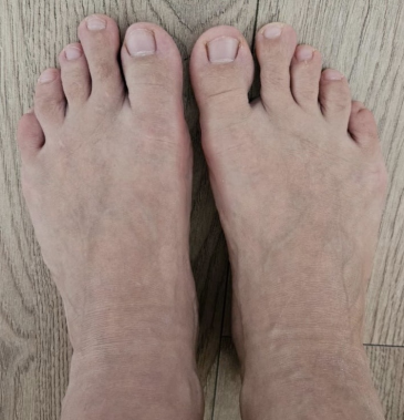 Hallux valgus после операции, халюс вальгус, халюс вальгус операция
