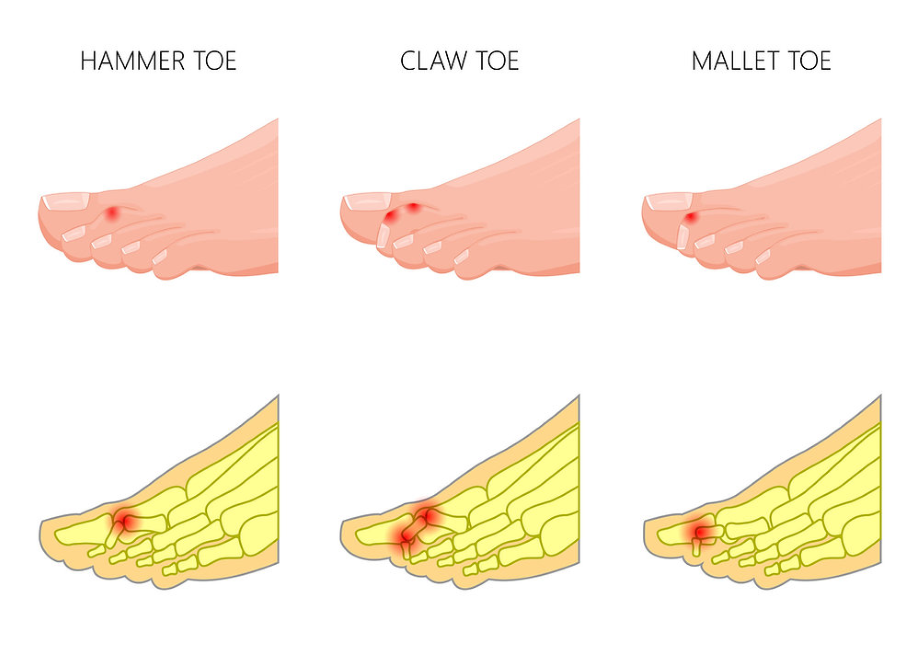 косточки на ноге операция, молоткообразные пальцы,
молоткообразная деформация пальцев,
молоткообразные пальцы стопы,
молоткообразная деформация пальцев стопы,
молоткообразные пальцы на ногах,
лечение молоткообразных пальцев,
молоткообразный палец операция,
молоткообразная деформация 2 пальца,
корректор молоткообразного пальца,
молоткообразный 2 палец стопы,
молоткообразный второй палец,
молоткообразные пальцы на ногах лечение,
молоткообразная деформация 2 пальца стопы,
молоткообразная деформация пальцев ног,
молоткообразные пальцы стопы операция,
лечение молоткообразной деформации пальцев,
молоткообразная деформация пальцев операция  
