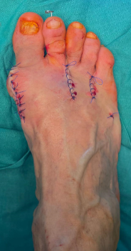 молоткообразные пальцы
молоткообразная деформация пальцев
молоткообразные пальцы стопы
молоткообразная деформация пальцев стопы
молоткообразные пальцы на ногах
лечение молоткообразных пальцев
молоткообразный палец операция
молоткообразная деформация 2 пальца
корректор молоткообразного пальца
молоткообразный 2 палец стопы
молоткообразный второй палец
молоткообразные пальцы на ногах лечение
молоткообразная деформация 2 пальца стопы
молоткообразная деформация пальцев ног
молоткообразные пальцы стопы операция
лечение молоткообразной деформации пальцев
молоткообразная деформация пальцев операция
молоткообразные пальцы причина
молоткообразный палец фото
лечение молоткообразного пальца стопы