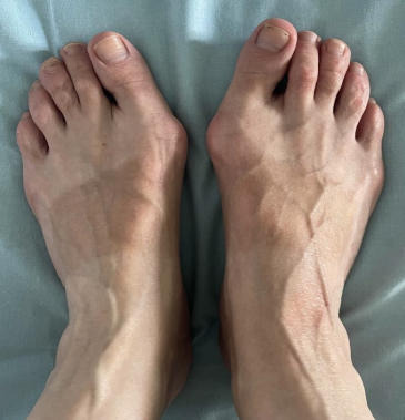 халюс вальгус операция, косточки на стопах ног лечение, косточки на стопах ног операция, удаление косточек на ногах, фото до SCARF остеотомии