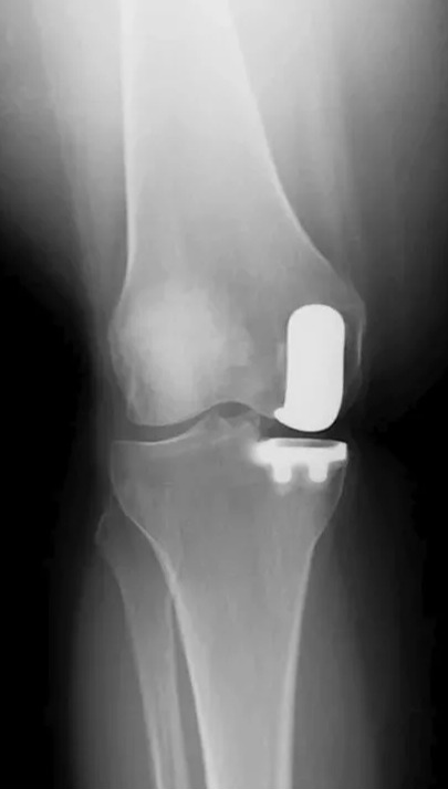 замена коленного сустава, эндопротезирование коленного сустава, искусственный коленный сустав, операция по замене коленного сустава, артроз коленного сустава 3 степени, протез коленного сустава, эндопротез, эндопротезирование коленного сустава Москва, эндопротезирование коленного сустава цена, одномыщелковое эндопротезирование, медиальный гонартроз лечение, артроз внутреннего мыщелка бедра.
