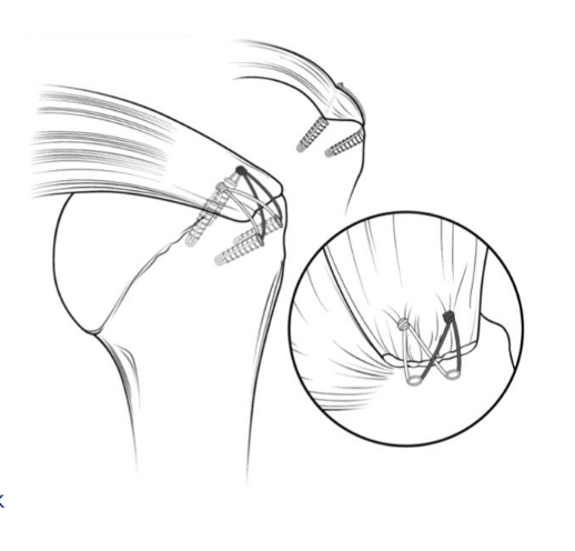 разрыв вращательной манжеты плечевого сустава лечение операция артроскопия