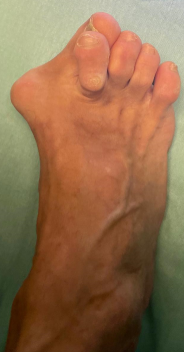 До SCARF остеотомии, молоткообразные пальцы молоткообразная деформация пальцев молоткообразные пальцы стопы молоткообразная деформация пальцев стопы молоткообразные пальцы на ногах лечение молоткообразных пальцев молоткообразный палец операция молоткообразная деформация 2 пальца корректор молоткообразного пальца молоткообразный 2 палец стопы молоткообразный второй палец молоткообразные пальцы на ногах лечение молоткообразная деформация 2 пальца стопы молоткообразная деформация пальцев ног молоткообразные пальцы стопы операция лечение молоткообразной деформации пальцев молоткообразная деформация пальцев операция молоткообразные пальцы причина молоткообразный палец фото лечение молоткообразного пальца стопы