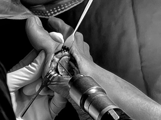 операции на шишках стоп, косточки на стопах ног лечение, операция удаления шишки на стопе, шишка на большом пальце стопы операция, косточка на стопе операция,  молоткообразные пальцы стопы операция, неврома мортона лечение, неврома мортона операция,  лечение молоткообразной деформации пальцев молоткообразная деформация пальцев операция