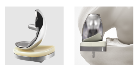 Артроз, артрит плечевого сустава, эндопротезирование плечевого сустава