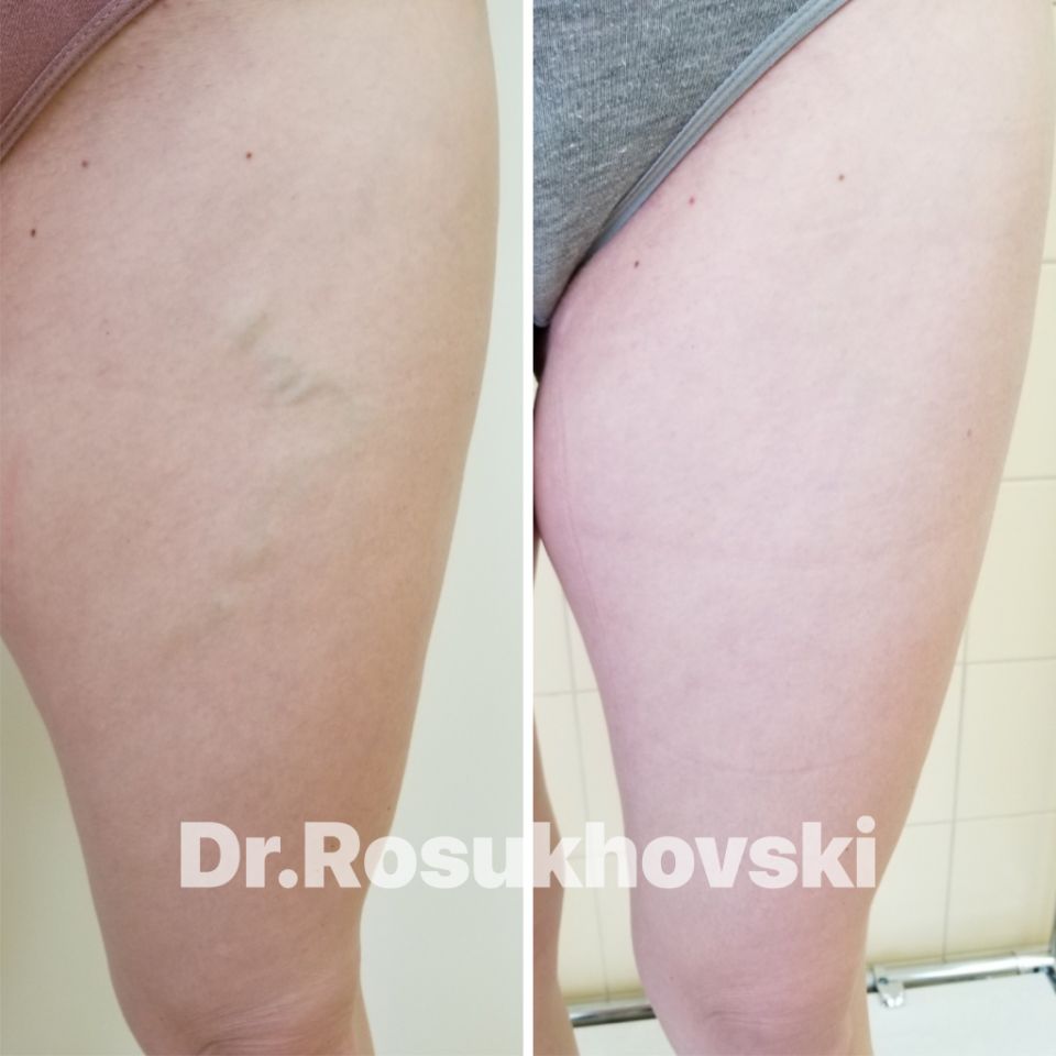 лечение варикоза лазером в спб