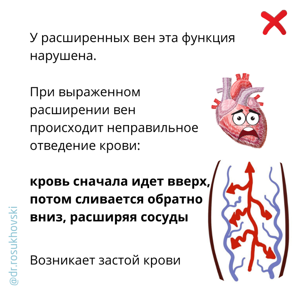 что такое варикоз