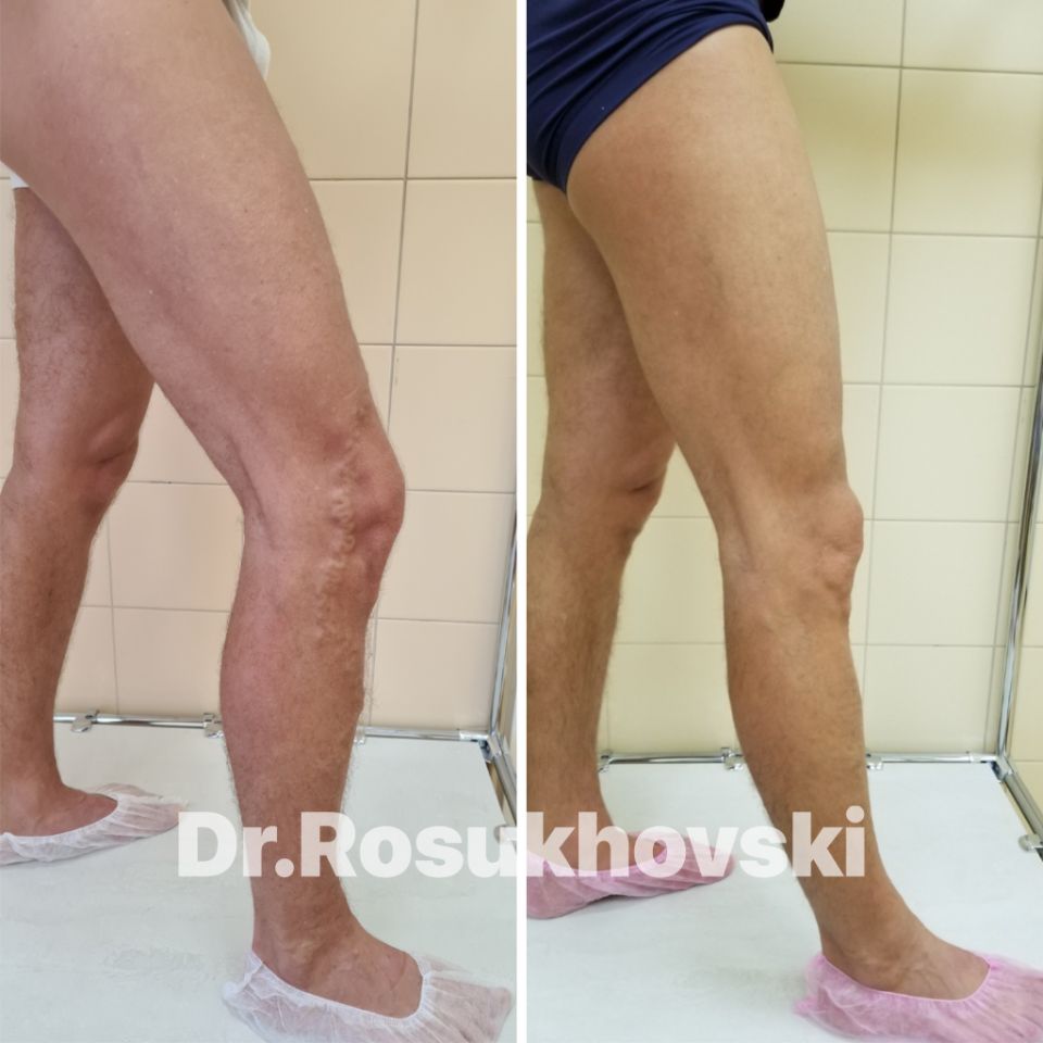 лечение варикоза лазером