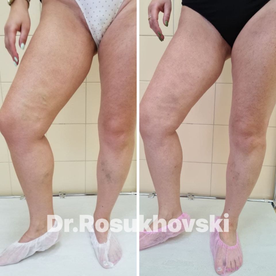 лечение варикоза