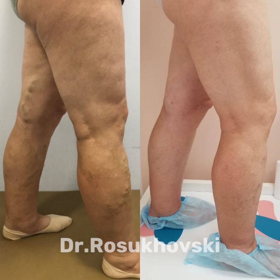 варикоз вен