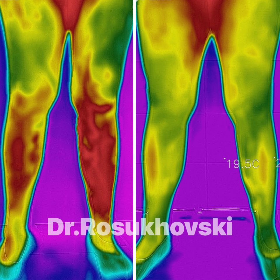 результат лечения варикоза