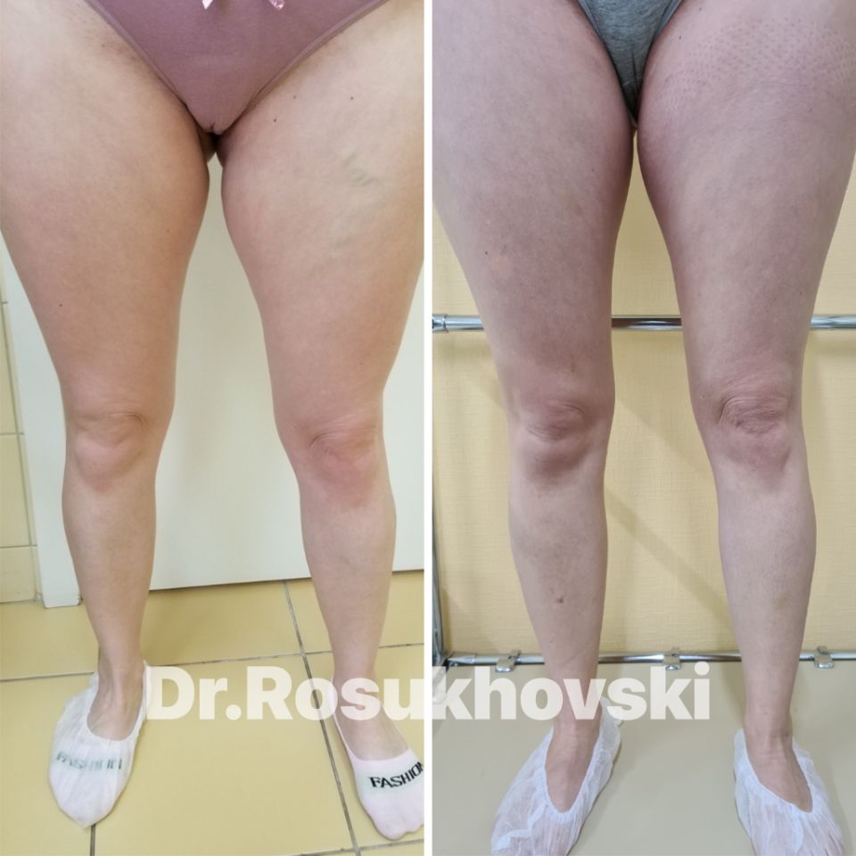 варикоз вен на ногах