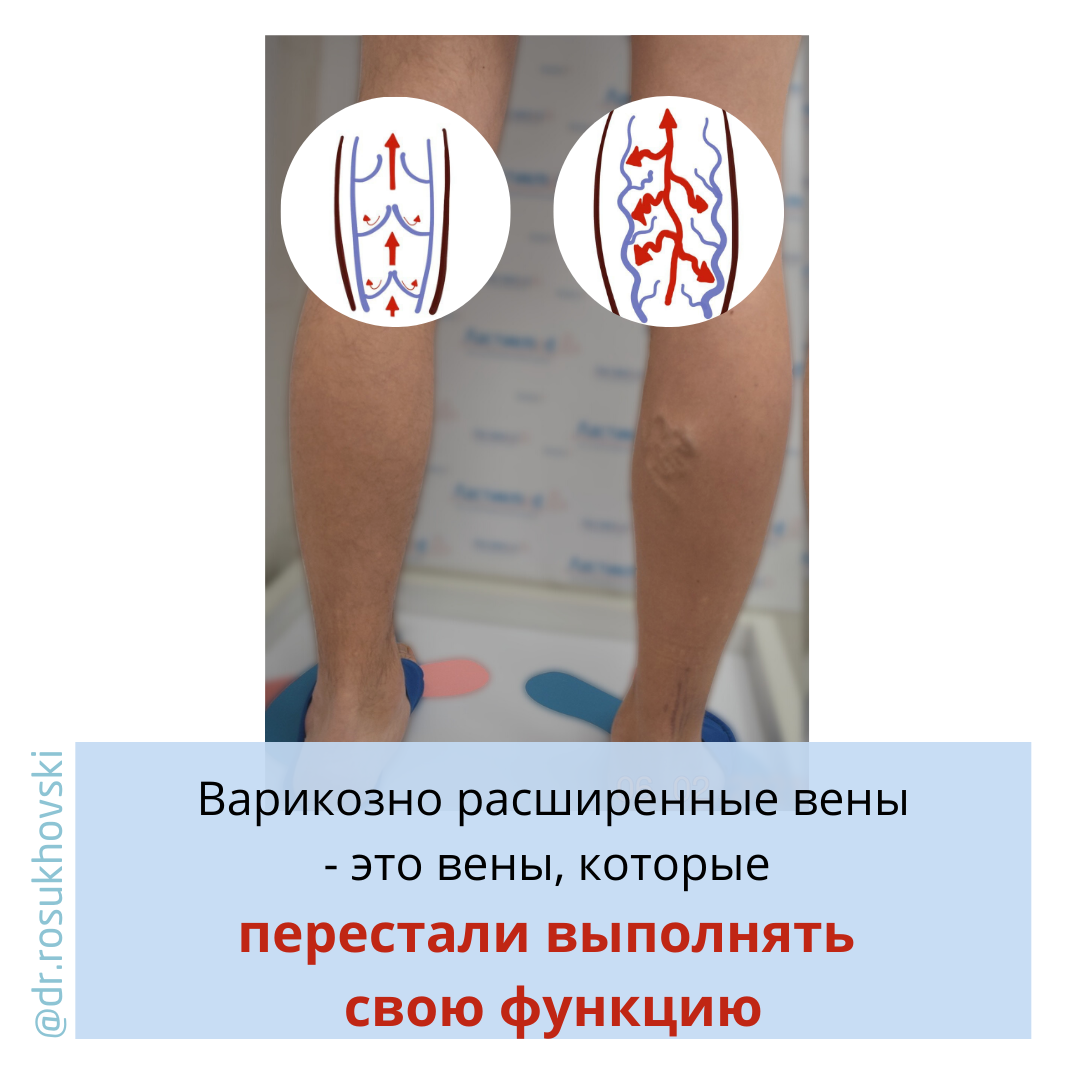 почему расширились вены