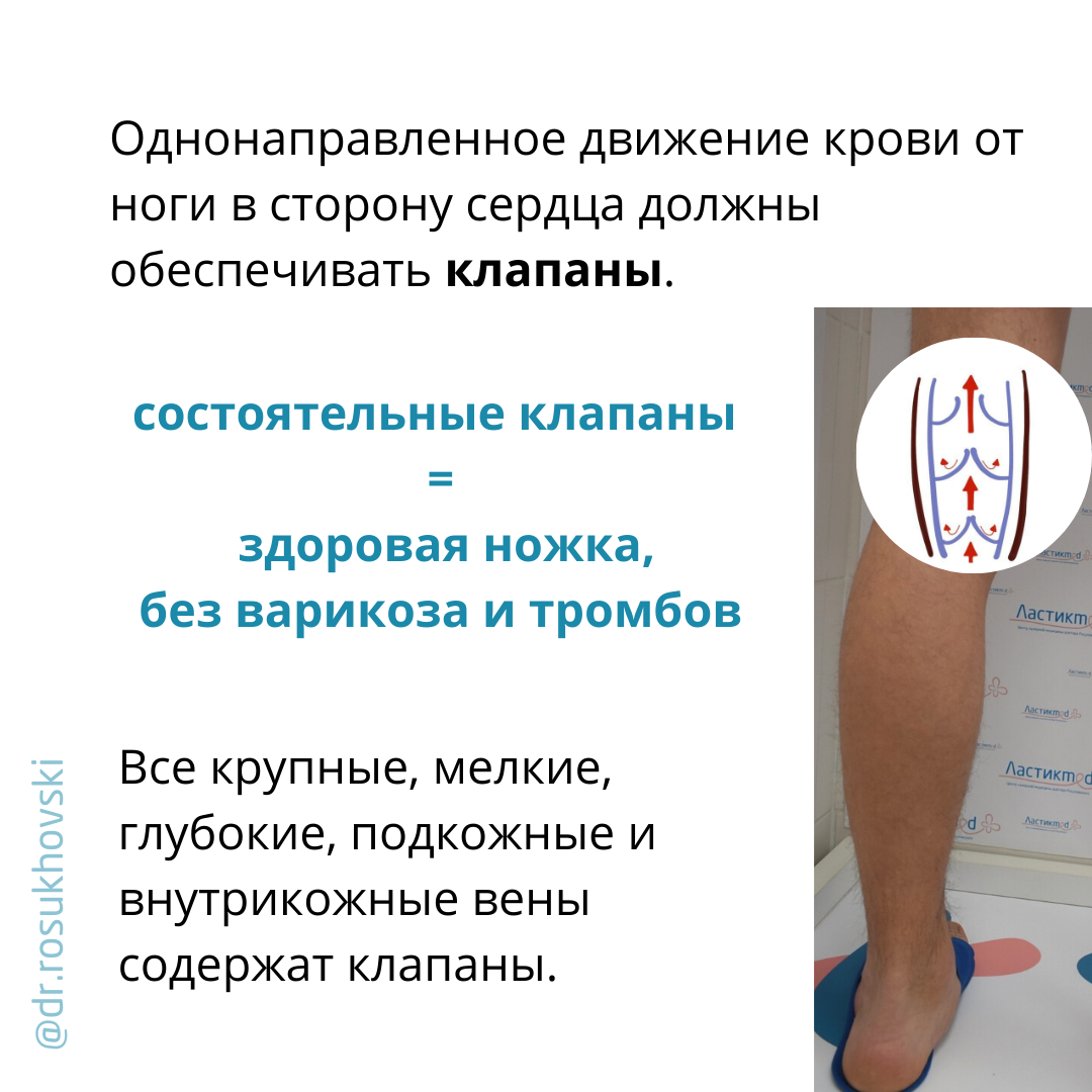 как образуется варикоз
