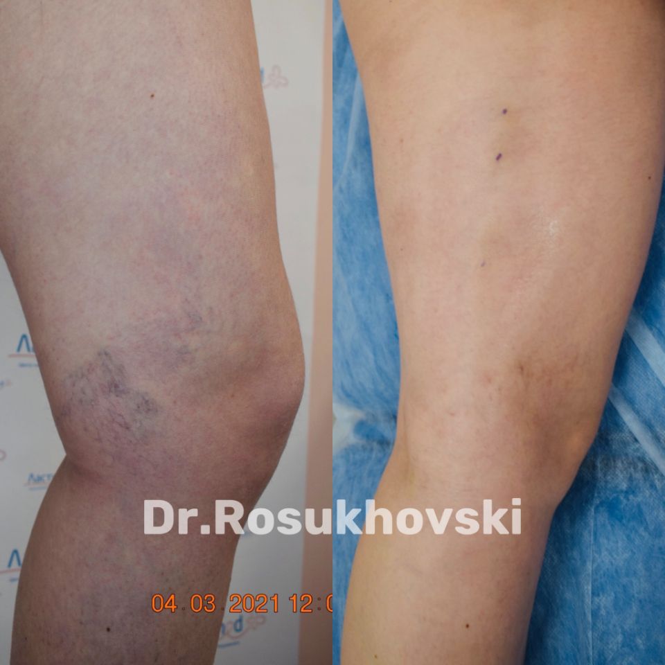 Устранение сосудистых звездочек