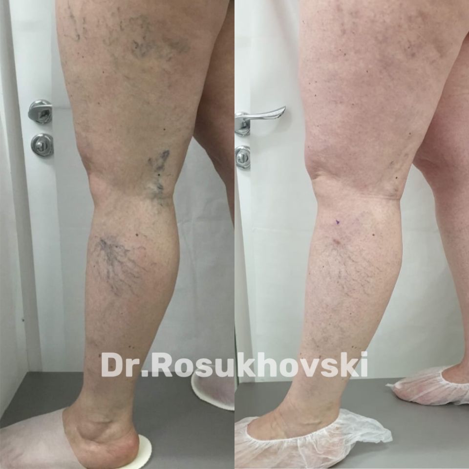 Устранение сосудистых звездочек