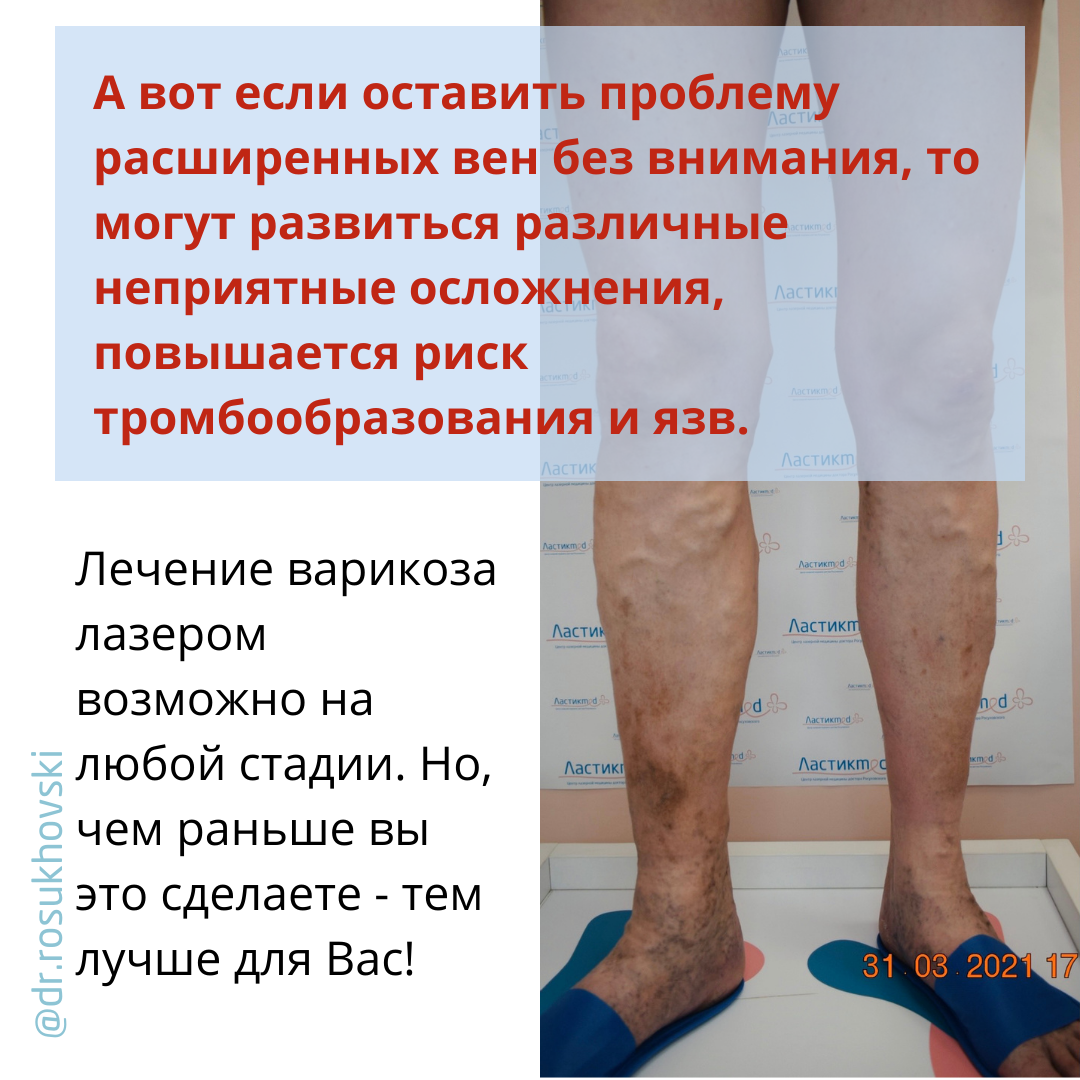 осложнения варикоза