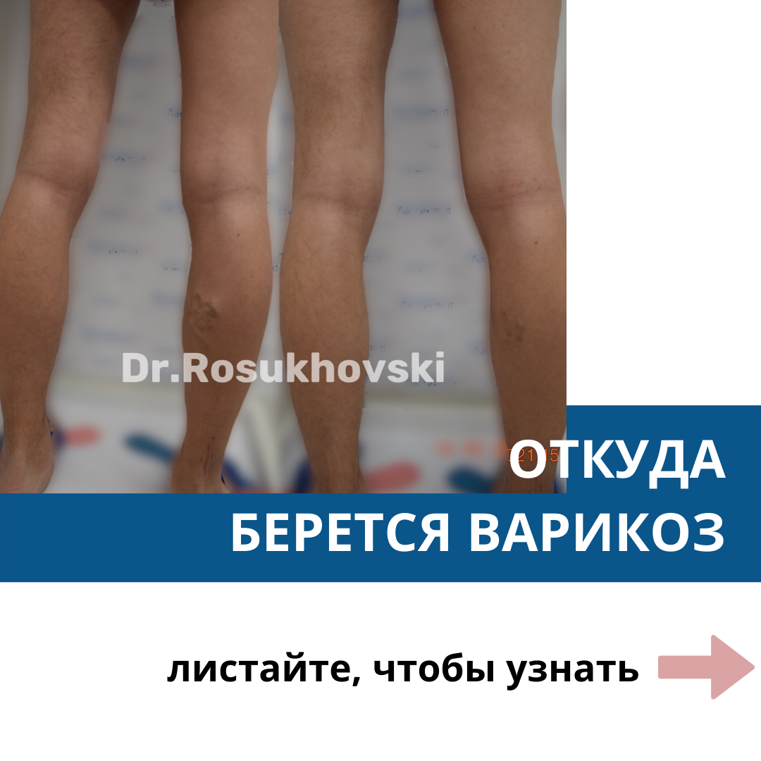 варикоз это