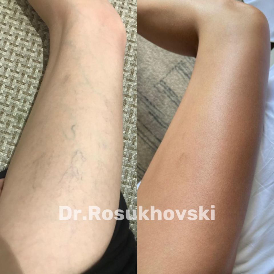 Устранение сосудистых звездочек