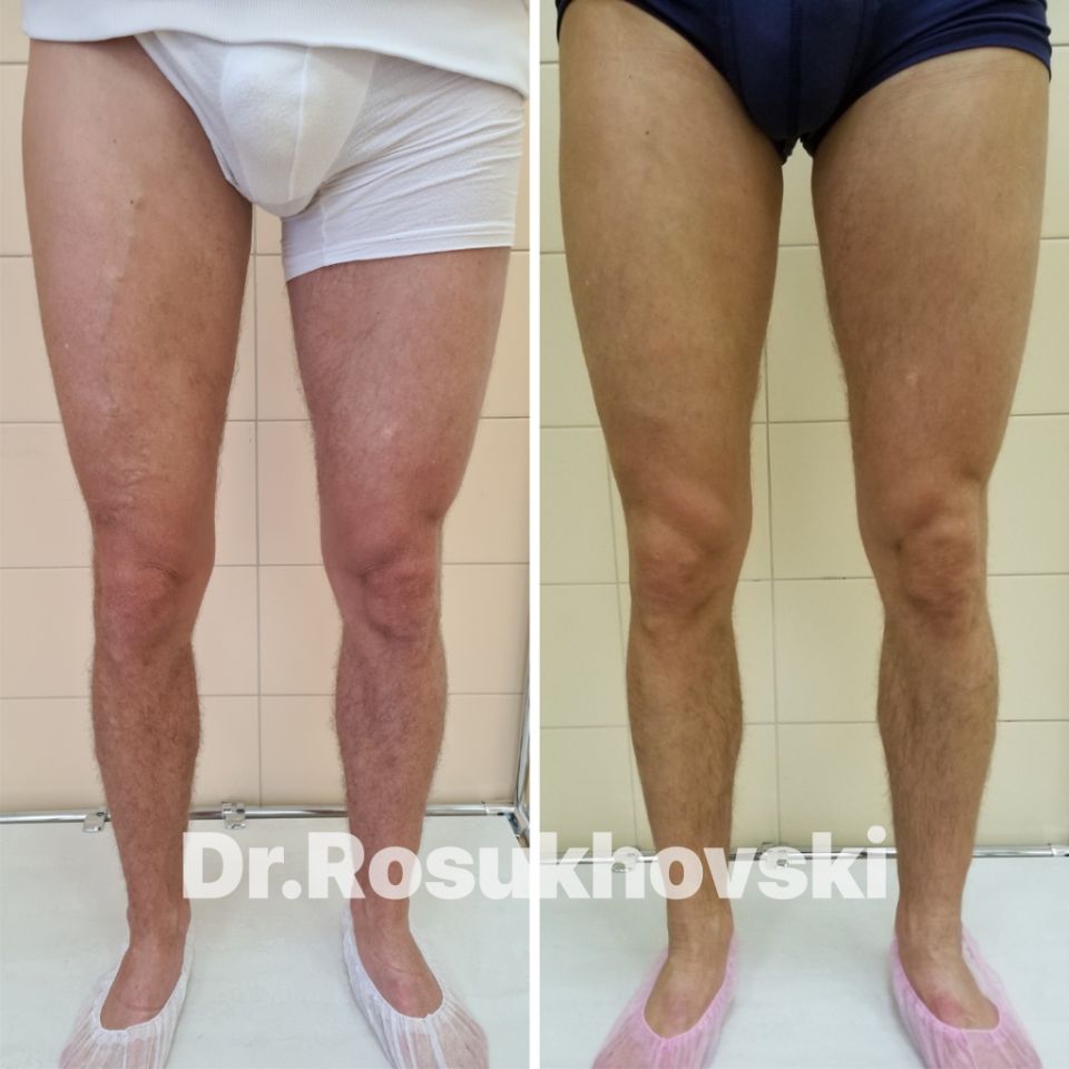 лечение варикоза спб