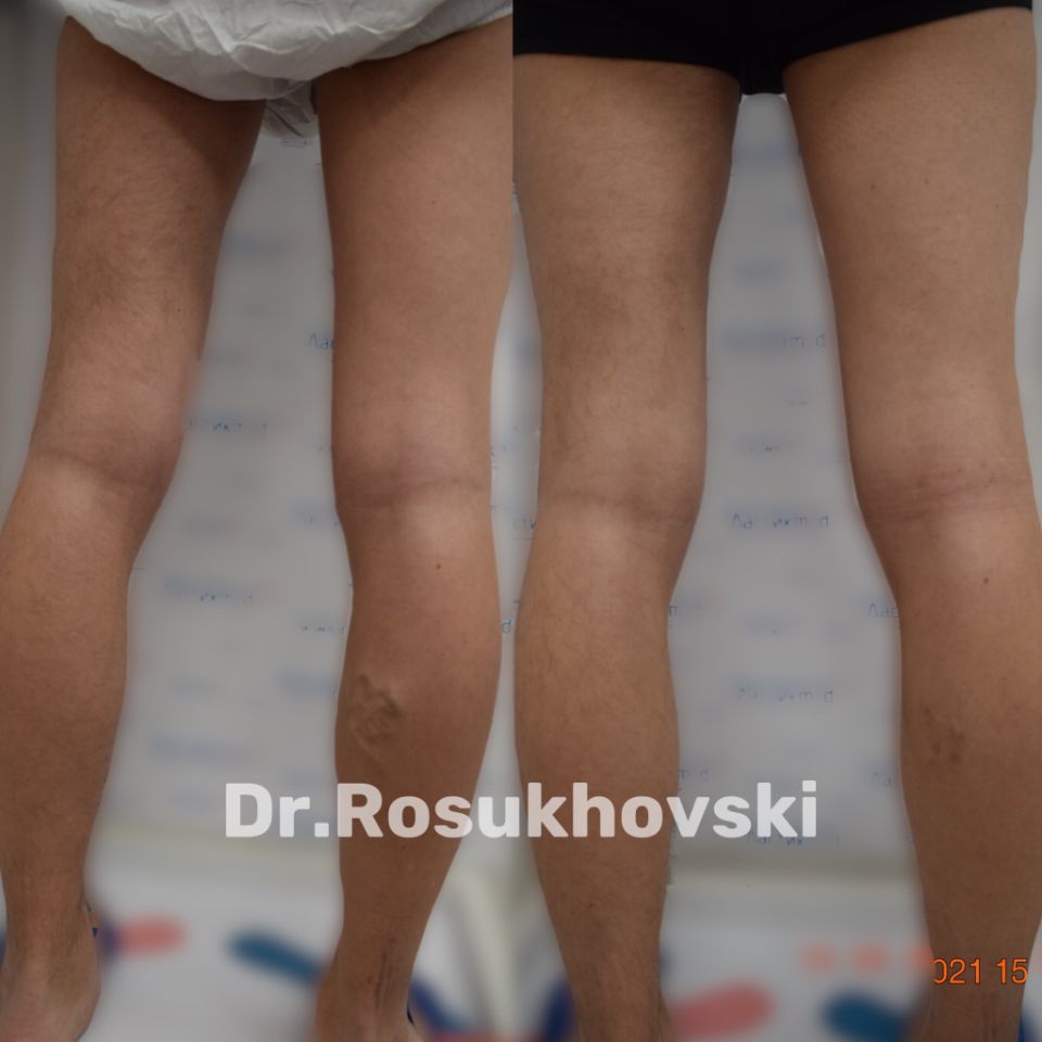 варикоз операция