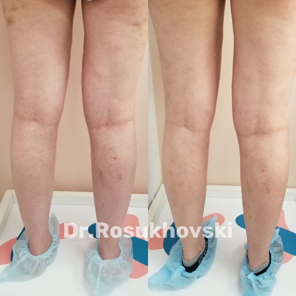 Устранение сосудистых звездочек