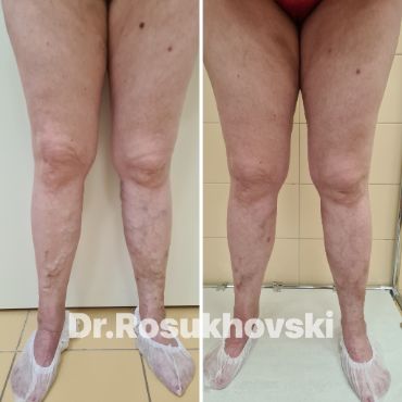 Фото тех же ножек до и после ЭВЛК