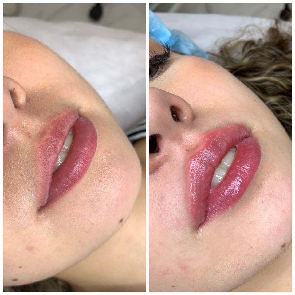 Увеличение губ