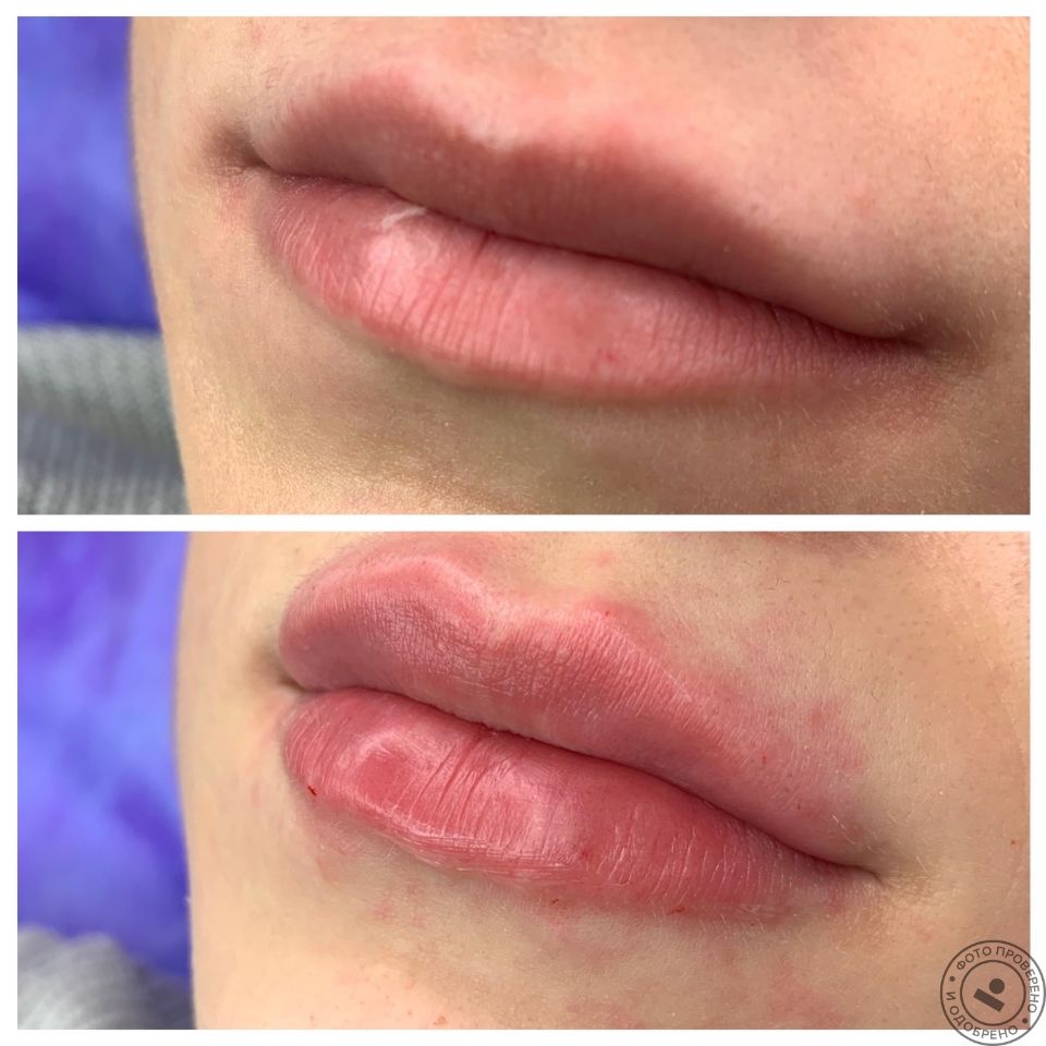 Увеличение губ