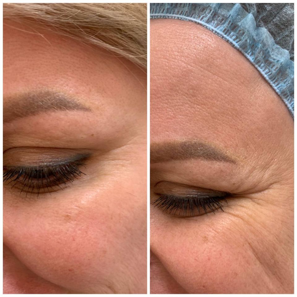 Ботулинотерапия