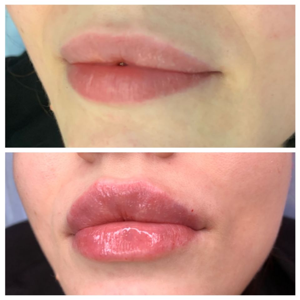 Увеличение губ