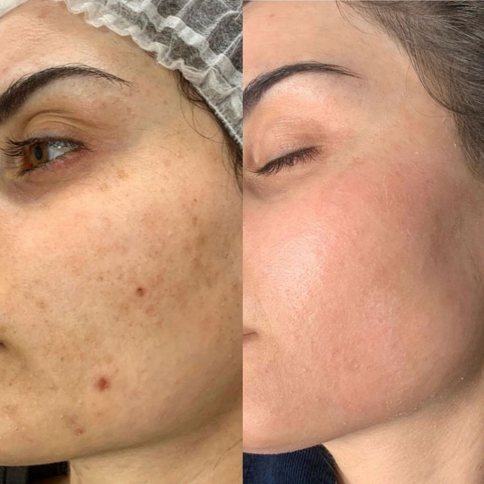 Пилинг ретиноловый (желтый)