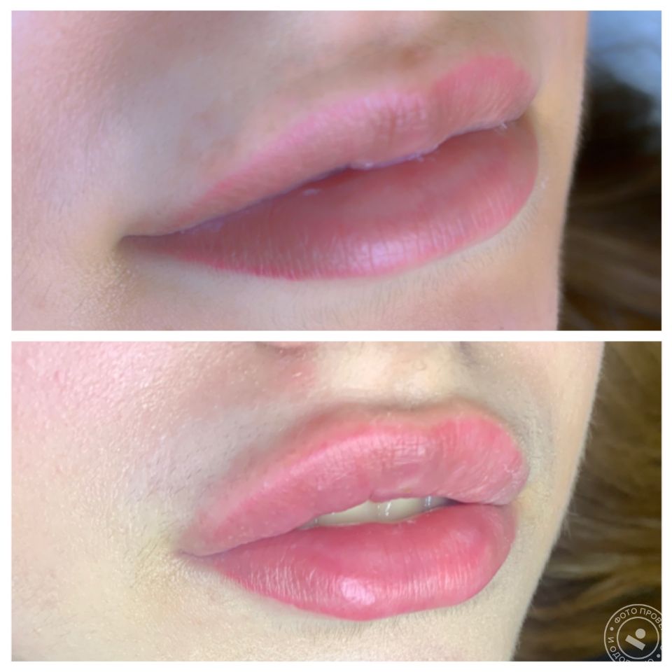 губы, пластикагубМосква, косметолог Москва