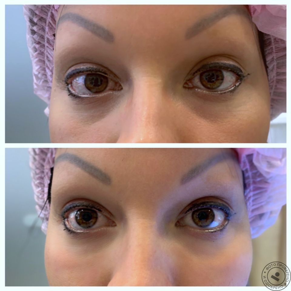 Коррекция носослезной борозды