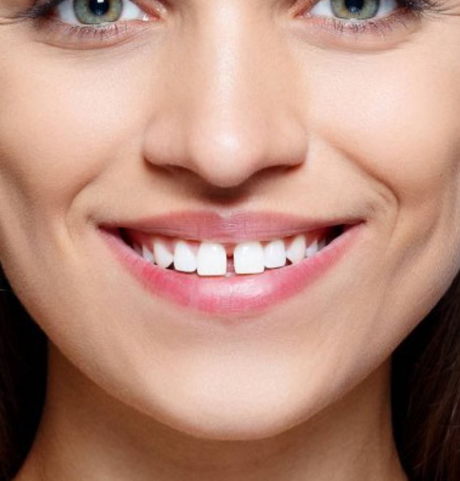 Щель между передними зубами