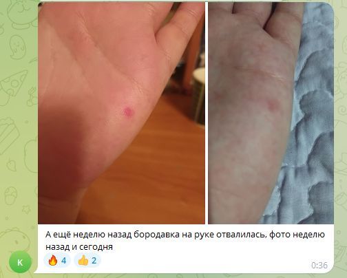 Отвалилась бородавка.