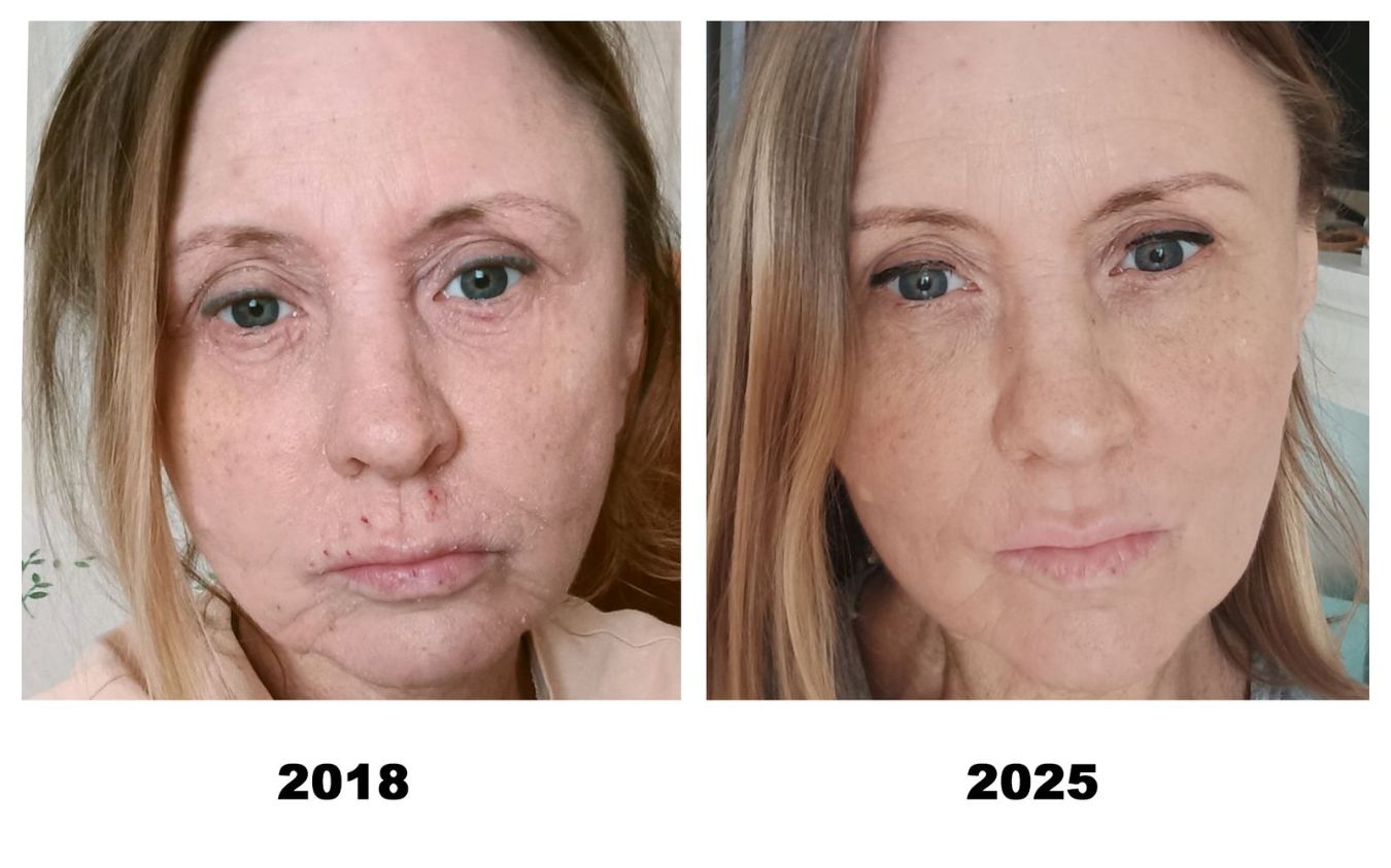 Экзема отступает