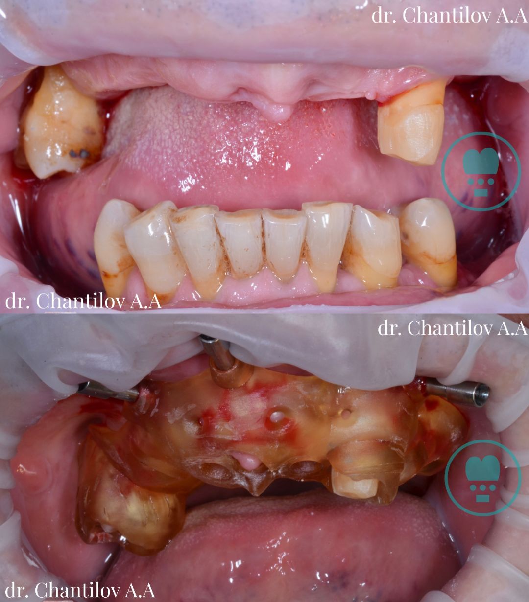 Хирургический этап протезирования верхней челюсти на 4 имплантатах