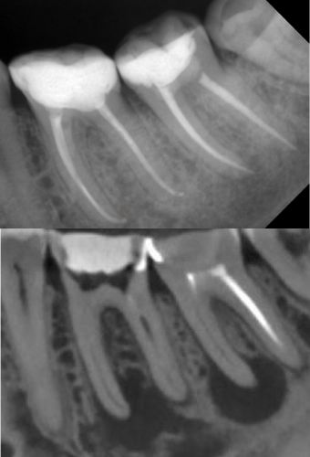 Лечение периодонтита