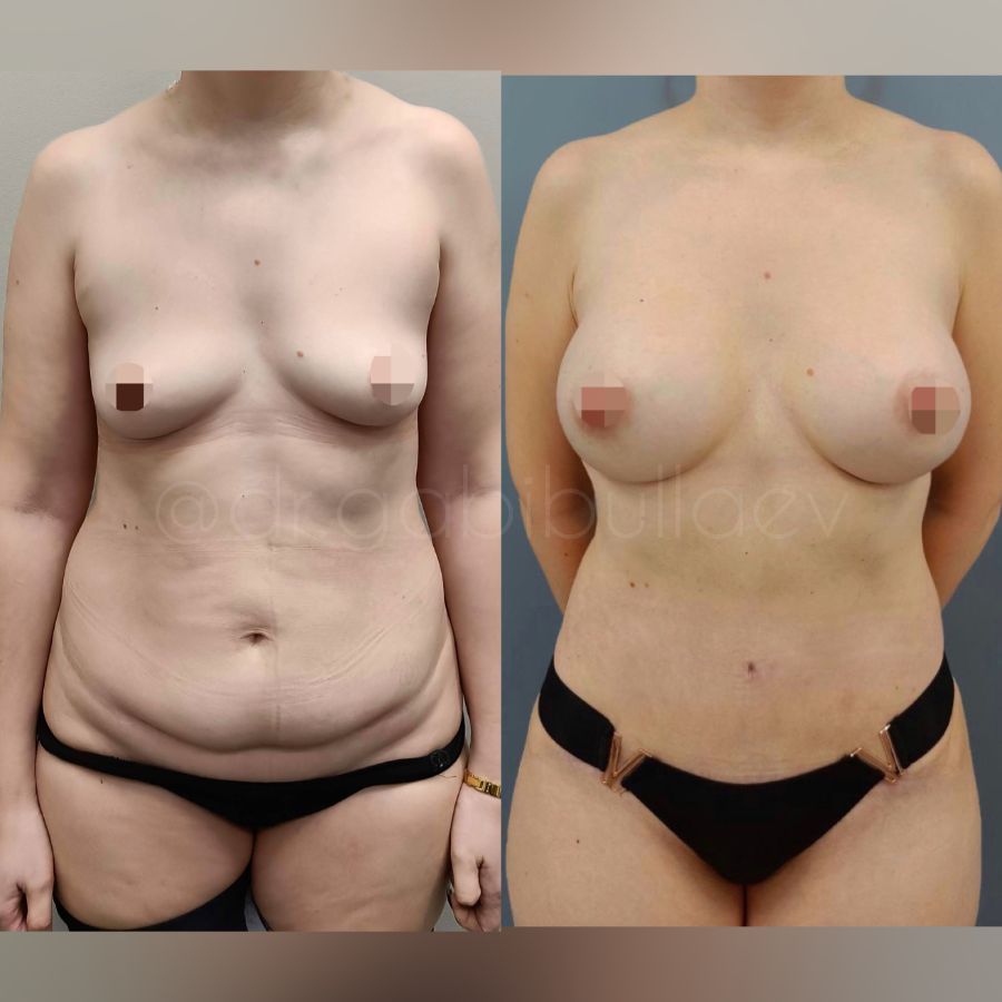 Увеличение груди имплантаим абдоминопластика