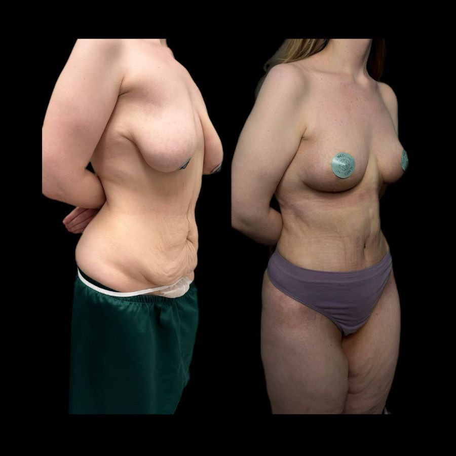 Абдоминопластика и подтяжка груди
