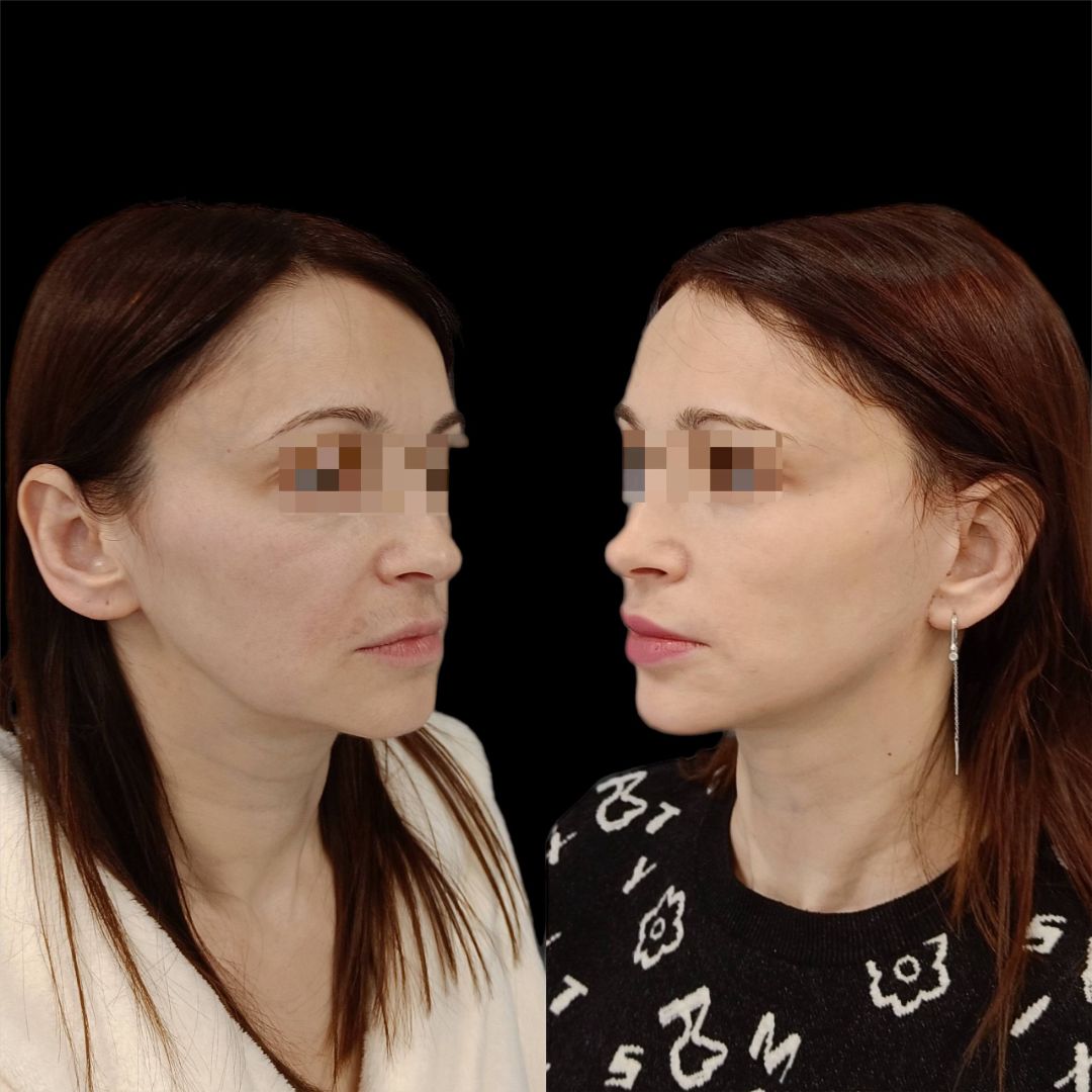 Круговая подтяжка лица