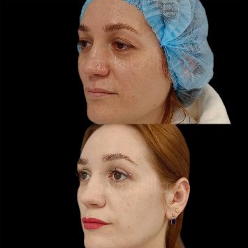 Круговая блефаропластика