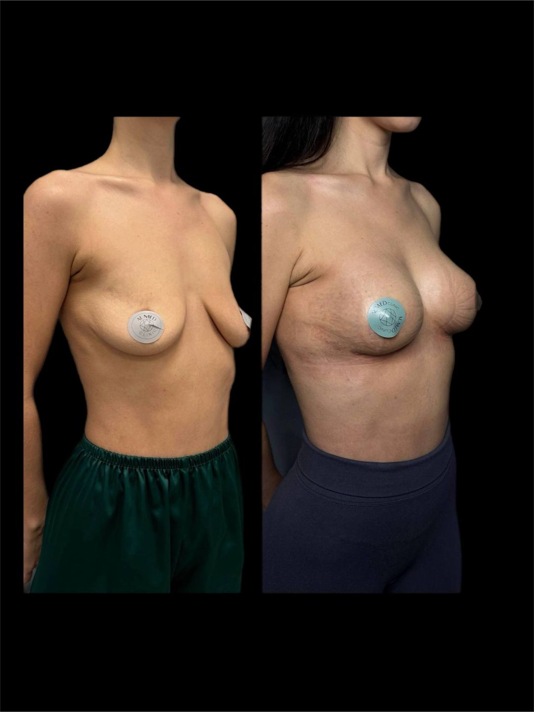 Маммопластика Краснодар