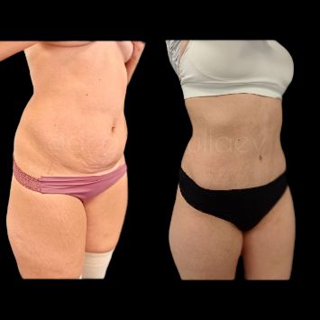 Липосакция живота с абдоминопластикой