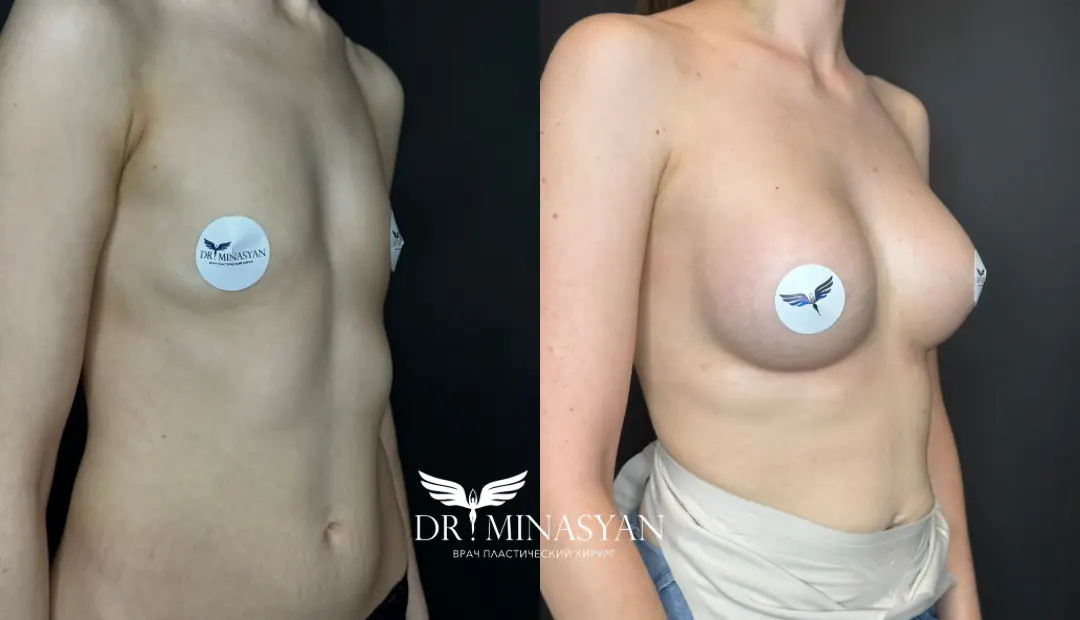 Пример работы доктора Минасяна Паруйра Наириевича в области маммопластики