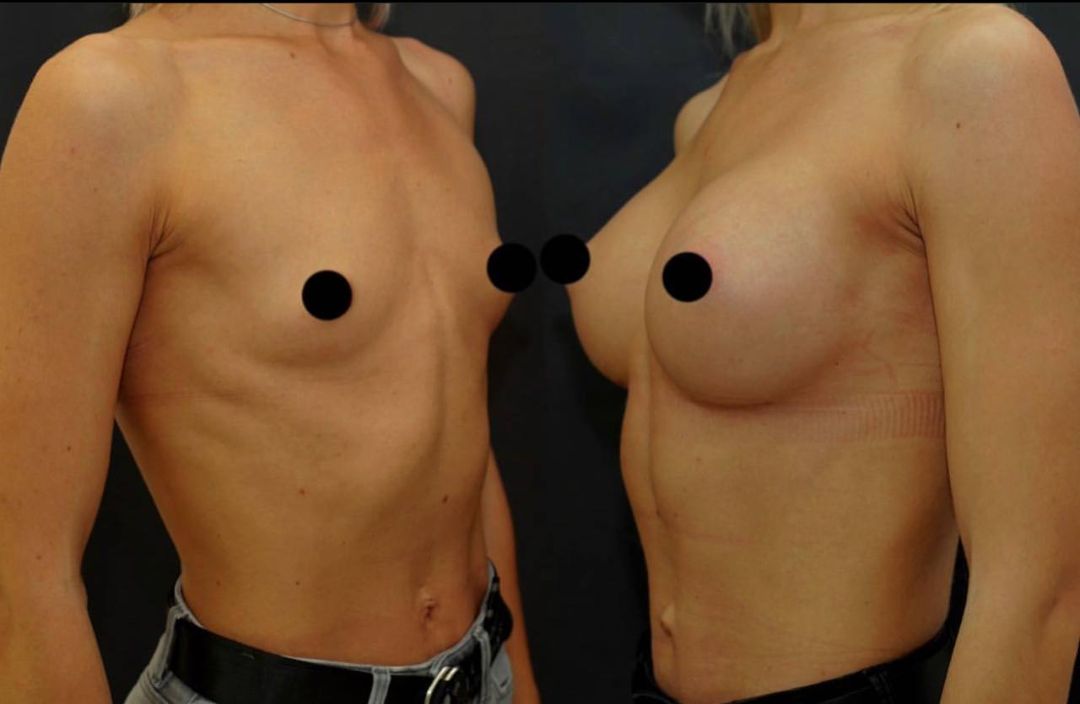 увеличение груди имплантами